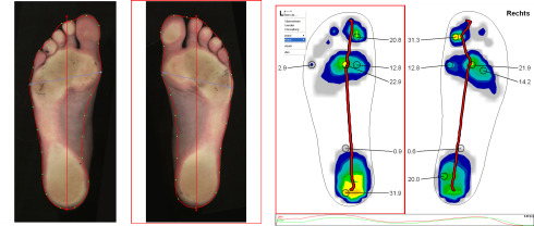 Misurazione Baropodometrica - Analisi del piede